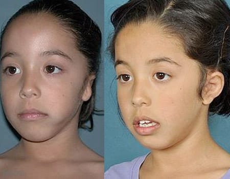 Microtia Reconstruction