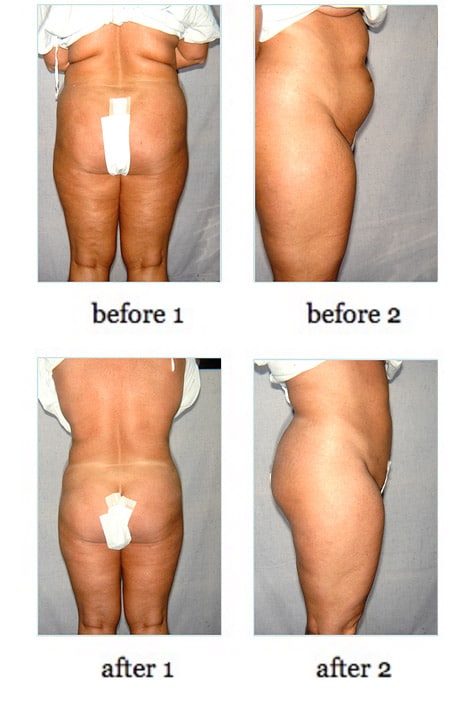 liposuction6