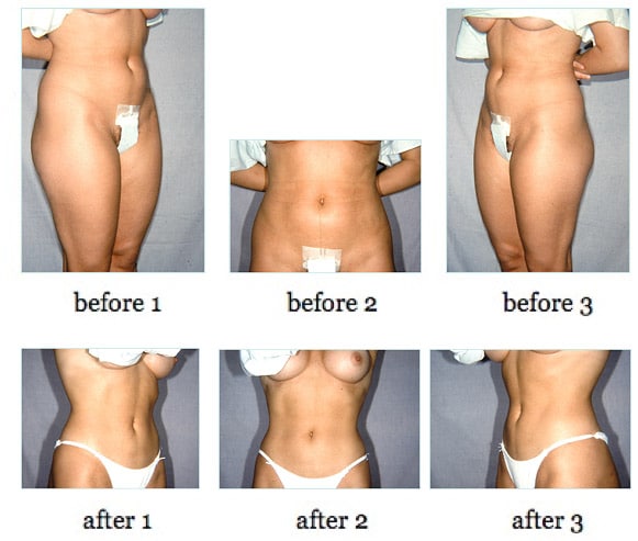 liposuction7