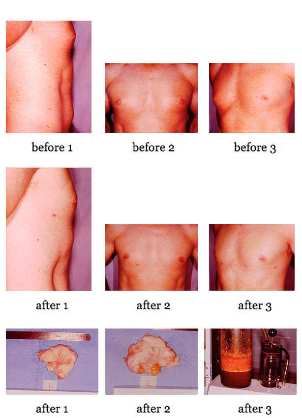 male breast reduction before and after