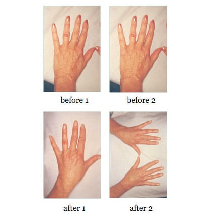 hand-rejuvenation before and after