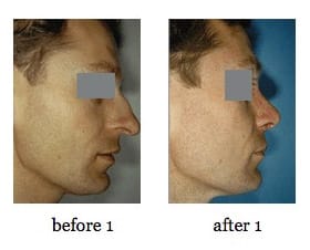 rhinoplasty-1