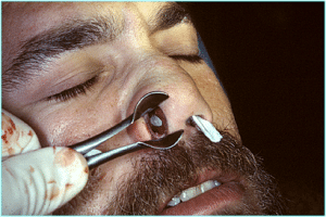 Nasal Septal Perforations before and after