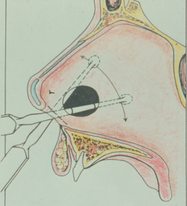 Septal Perforation