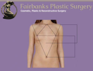 Fairbanks Plastic Surgery - Nipple Location with Mastopexy
