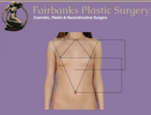 Fairbanks Plastic Surgery - Nipple Location with Mastopexy