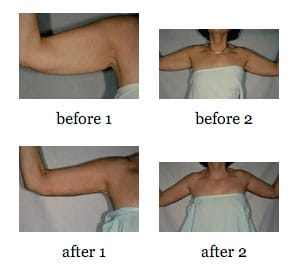 Arm Lift before and after