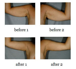 Arm Lift before and after