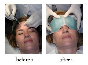 botox