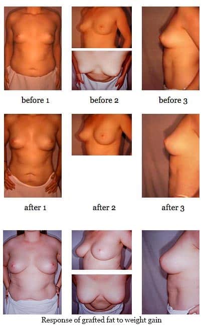 Breast Enlargement Through Fat Grafting before and after