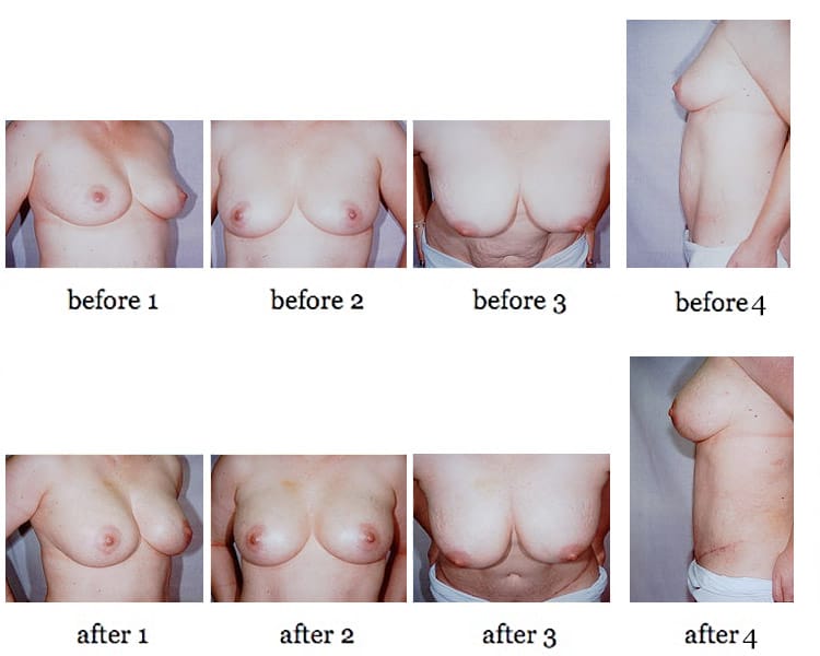 breast-aug-fat-4