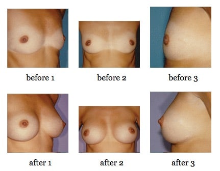 breast augmentation before and after