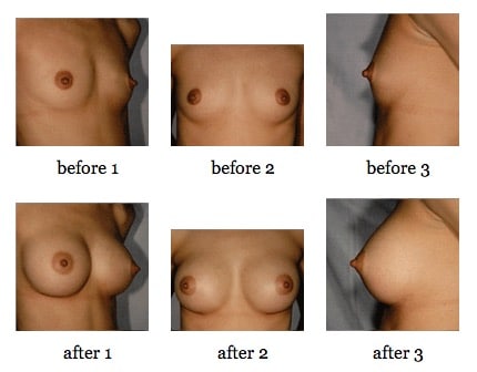 breast augmentation before and after