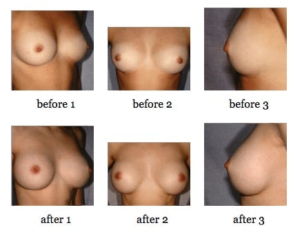 breast augmentation before and after