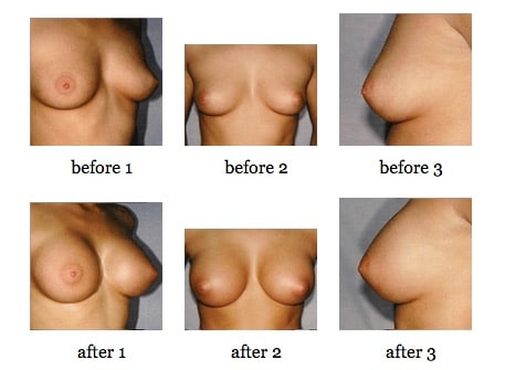 breast augmentation before and after