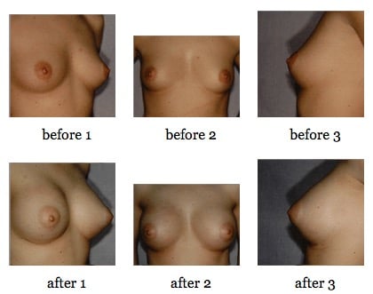 breast augmentation before and after