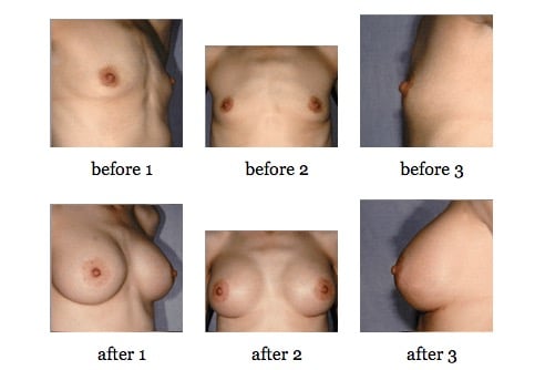 breast augmentation before and after