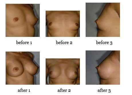 breast augmentation before and after