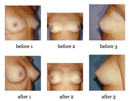 breast augmentation before and after