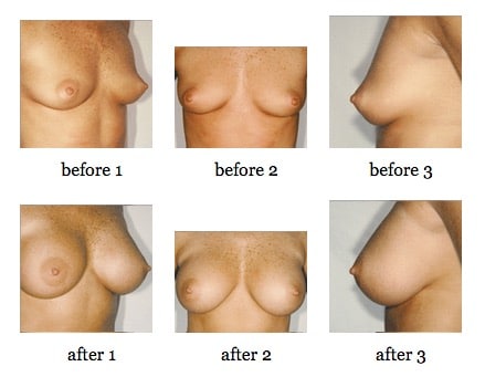 breast augmentation before and after