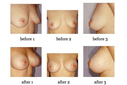 breast augmentation before and after