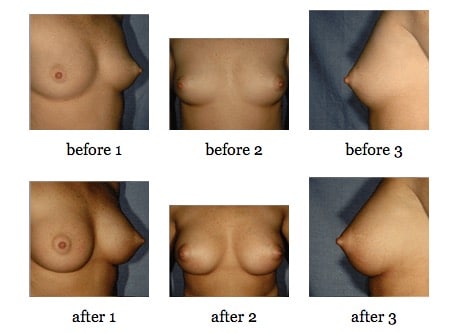 breast augmentation before and after