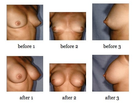 breast augmentation before and after