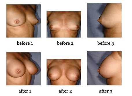 breast augmentation before and after