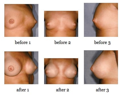 breast augmentation before and after