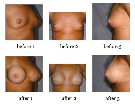 breast augmentation before and after