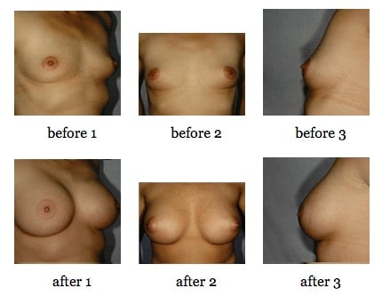 breast augmentation before and after