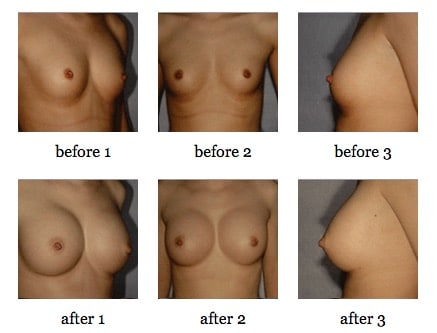 breast augmentation before and after