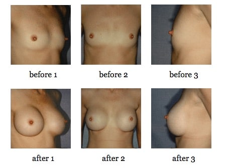 breast augmentation before and after