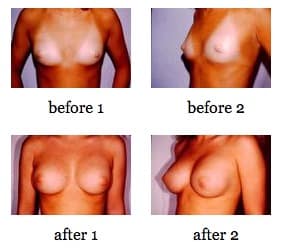 breast deformities before and after