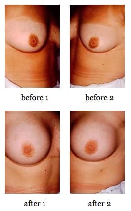 breast deformities before and after