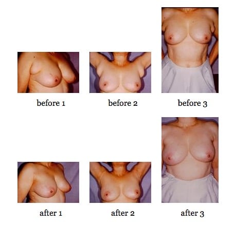 breast deformities before and after