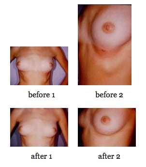 breast deformities before and after