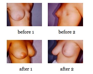 breast deformities before and after