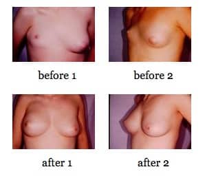 breast deformities before and after