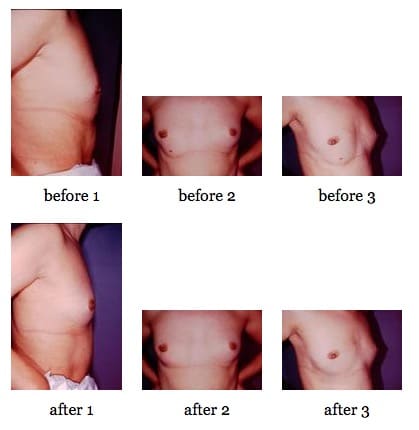 breast deformities before and after