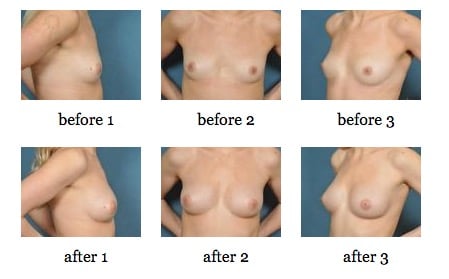 Breast Enlargement Through Fat Grafting before and after