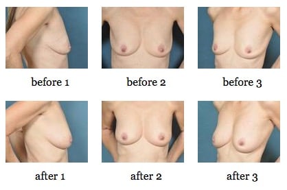 Breast Enlargement Through Fat Grafting before and after