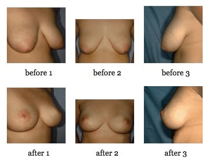 breast lift before and after