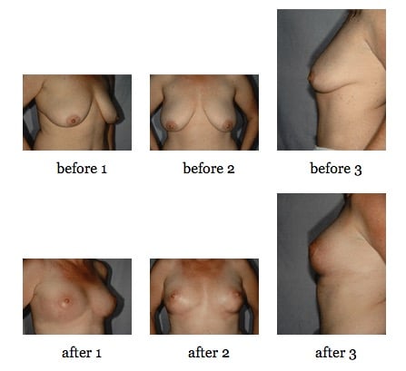 breast lift before and after