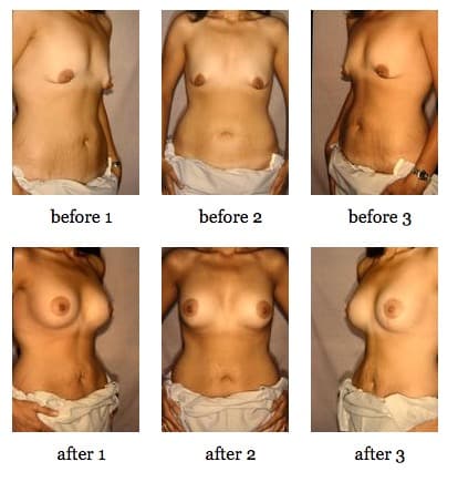 breast lift before and after