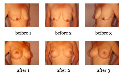 breast lift before and after