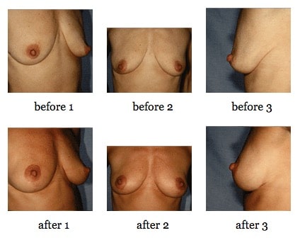 breast lift before and after