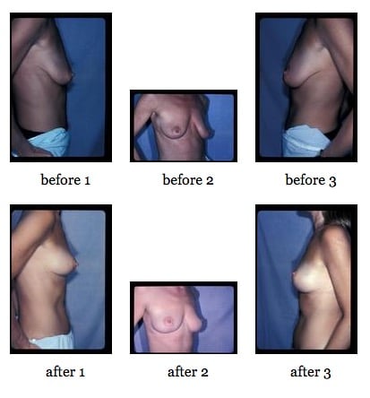 breast lift before and after