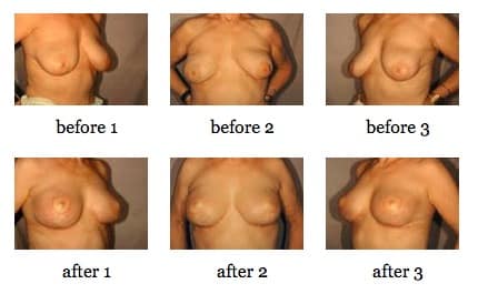 breast lift before and after