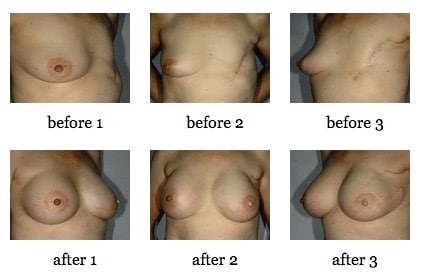 breast reconstruction surgery before and after